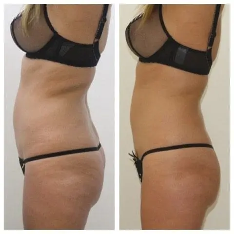 3D Lipo Example