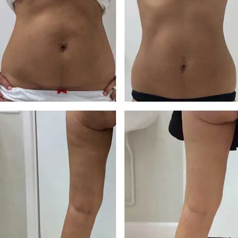 3D Lipo Example