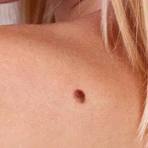 Skin Cancer