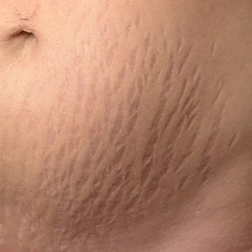 Stretch Marks