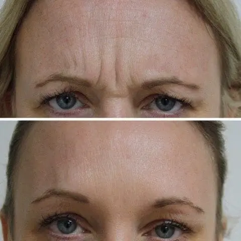 Botox Example 01