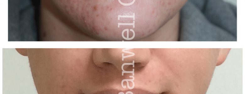 Acne and congestion