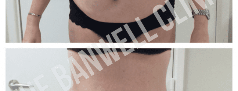 3D-lipo at The Banwell Clinic